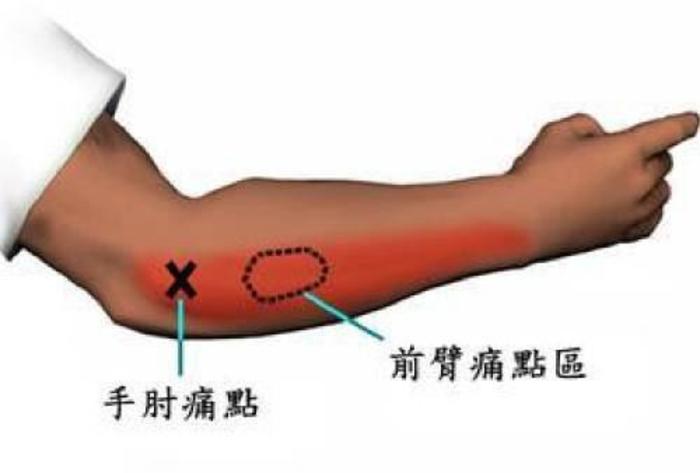 疼痛会向上或向下放射,有的人便会因为感觉酸胀不适应,不愿意活动肘部