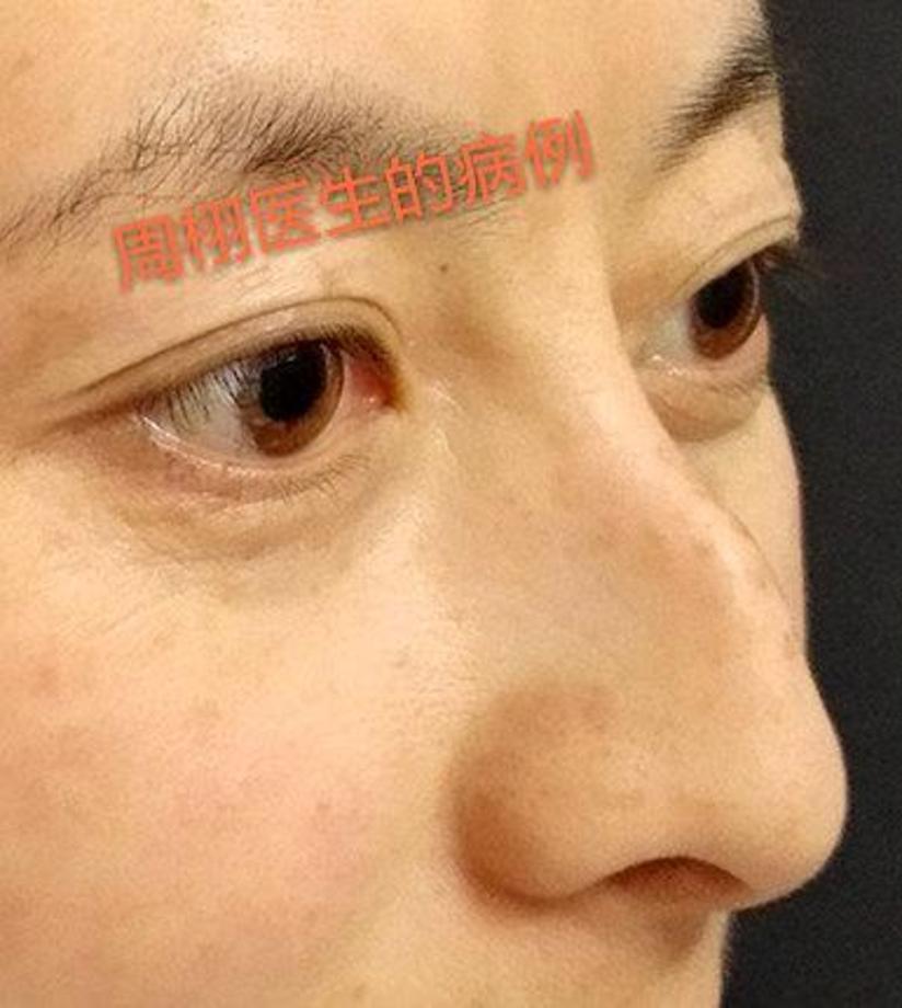 驼峰鼻 整形 健康号 微医