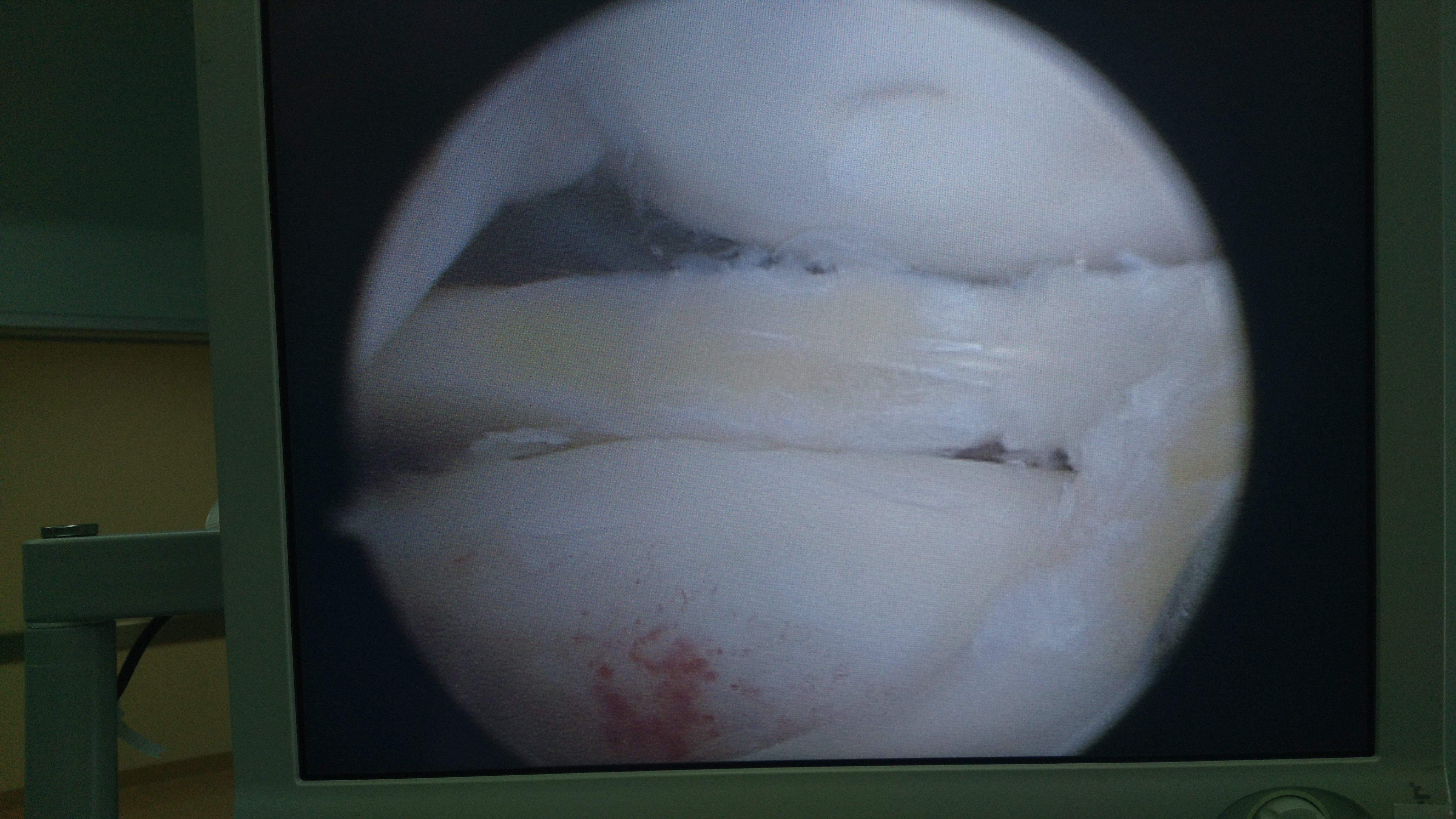 膝关节盘状半月板损伤关节镜下成形术