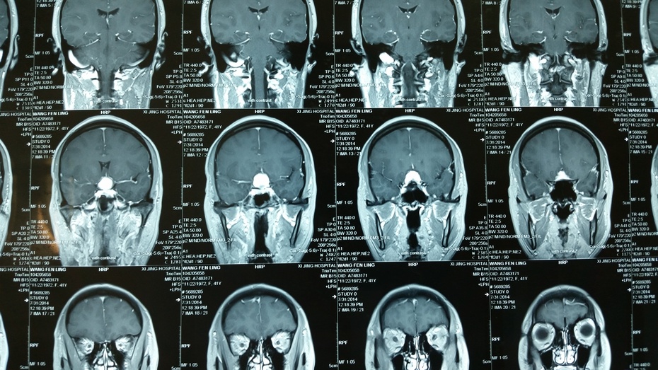 贺晓生教授手术回放鞍结节脑膜瘤手术切除