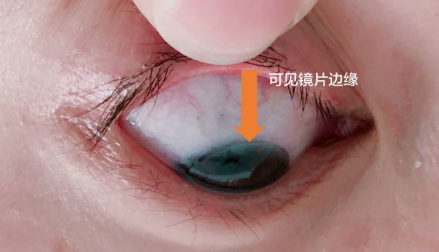 早上摘镜三确认