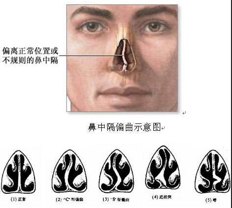 鼻中隔偏曲需要手术吗什么手术方式更微创
