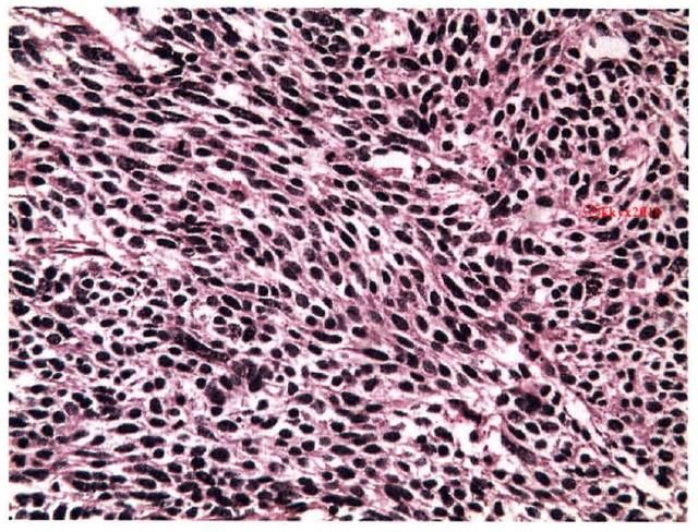 肺腺癌:癌细胞沿肺泡壁呈多层生长,形似腺样结构,有乳头形成,肺泡间隔