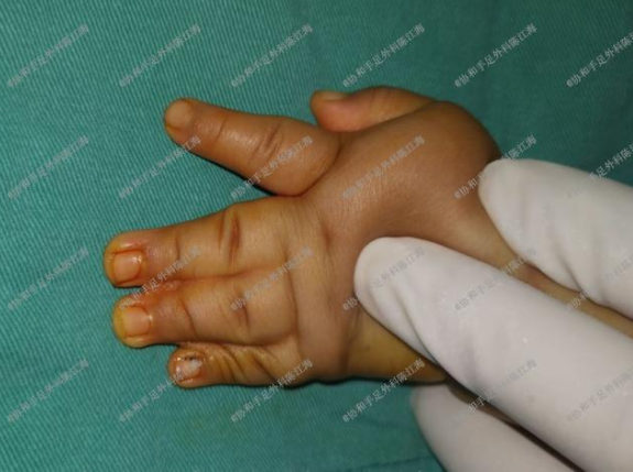 宝宝手足畸形和高龄产妇有没有关系?