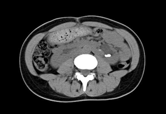 ct显示先天性马蹄肾畸形,左肾多发结石病例四:2016年6月门诊患者:先天