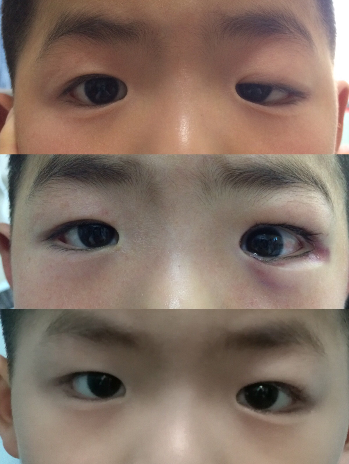 小朋友眼皮下垂该怎么改善?