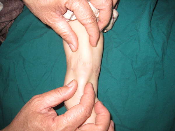 先天性束带综合症的治疗