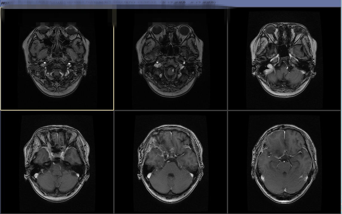 顱底巨大腦膜瘤切除術前術後對比cusa是利器