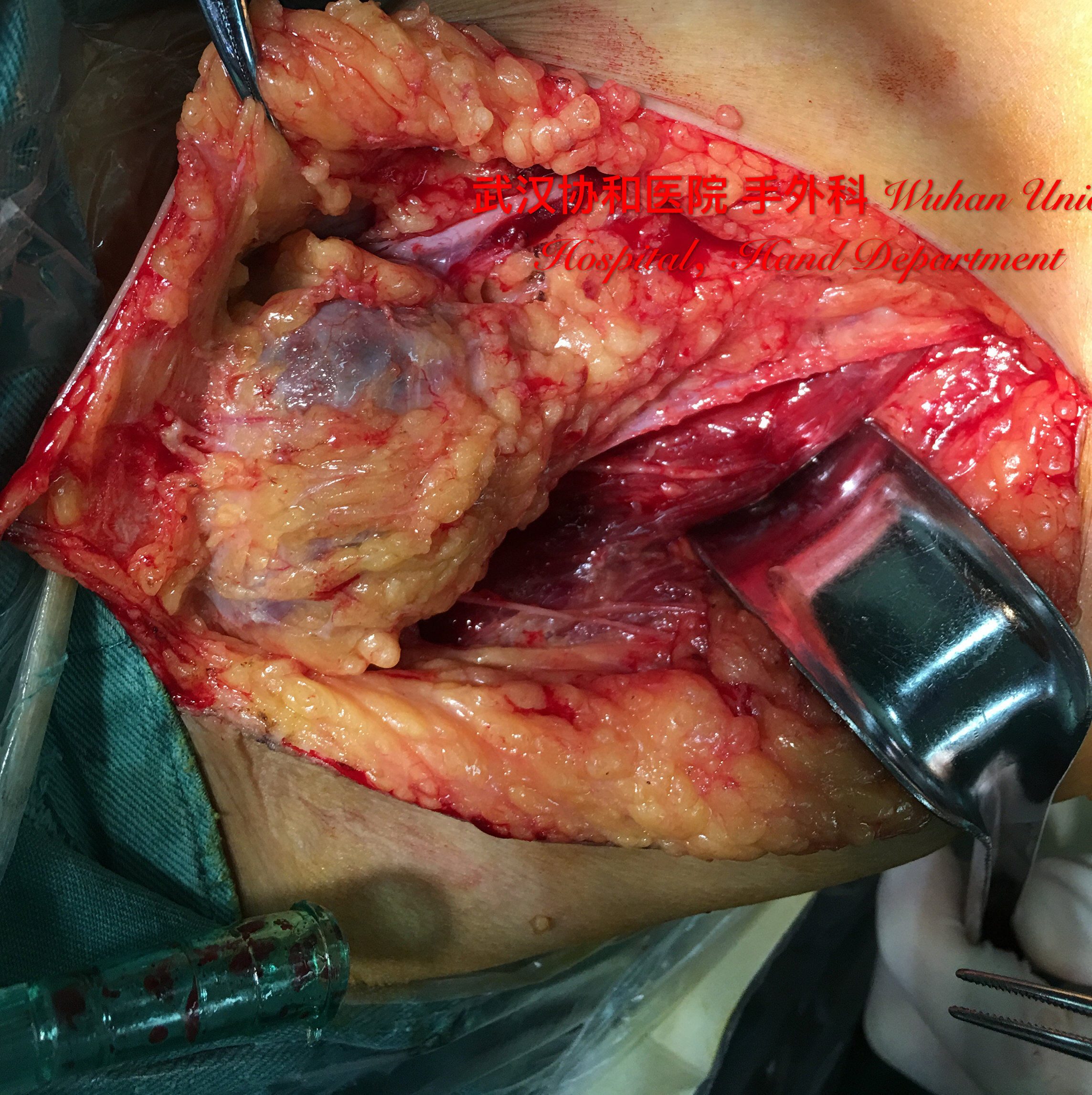 皮肤恶性黑色素瘤发生淋巴结转移后的伤口治疗