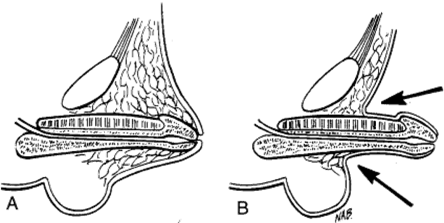"长不大"的「命根子」隐匿型阴茎,手术治疗帮你挽救性福.