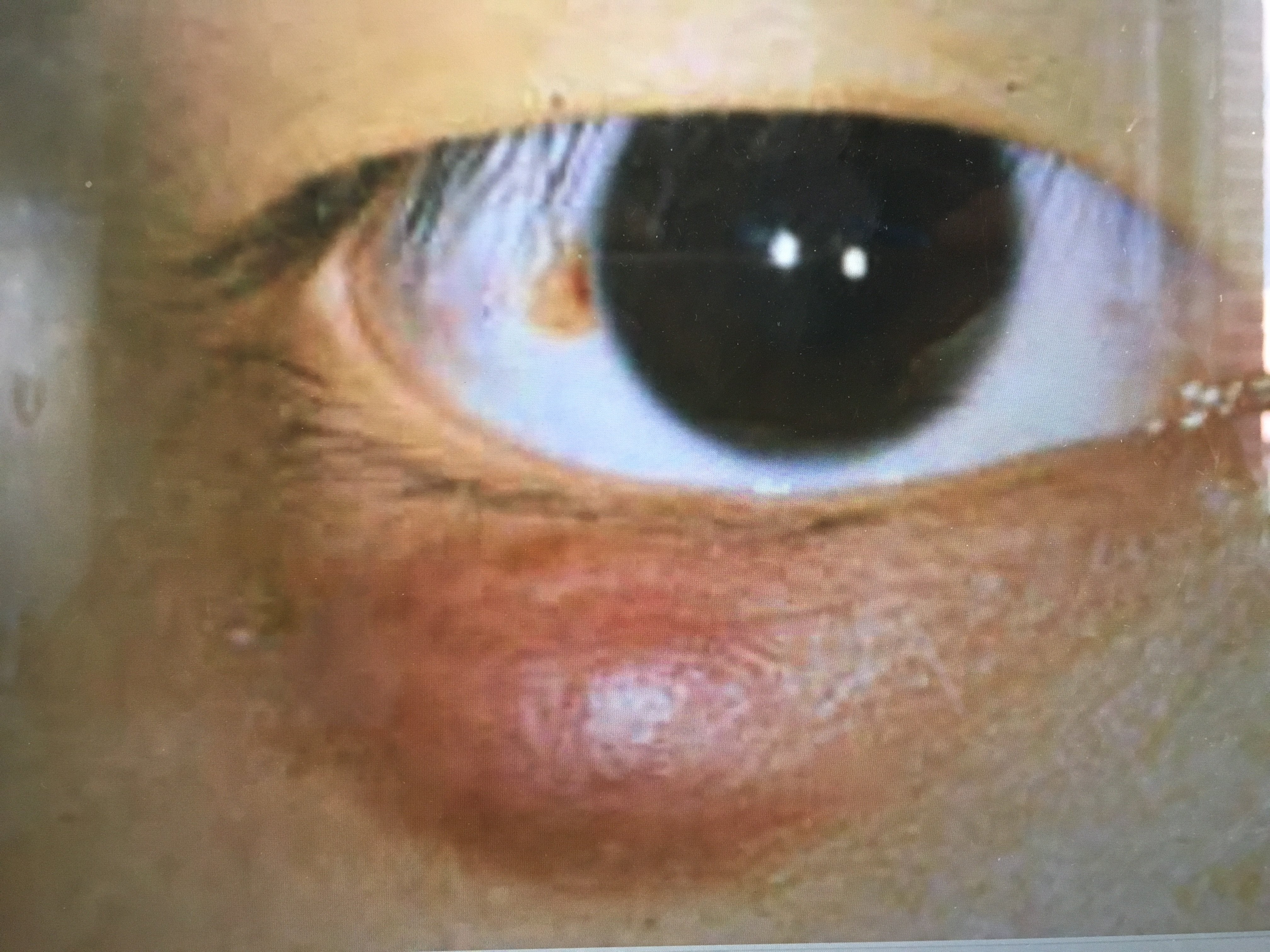 麦粒肿又称睑腺炎,大部分与细菌感染有关.表现为局限性红.肿.热.