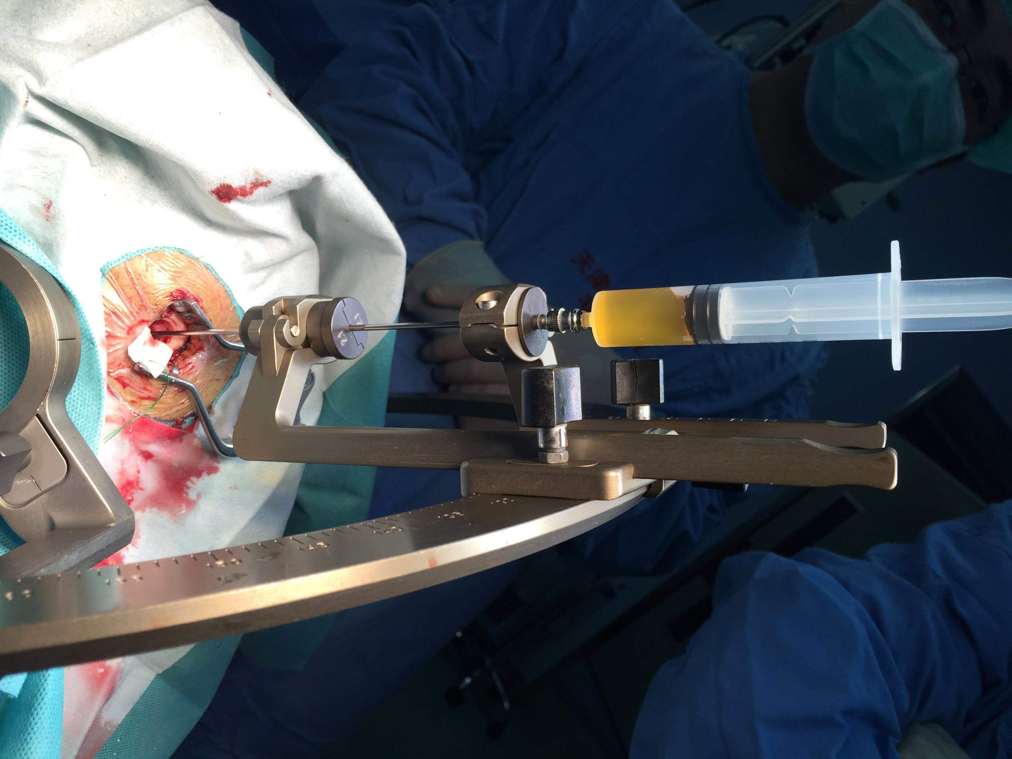 介绍一例巨大多囊颅咽管瘤聋哑患者的微创手术治疗