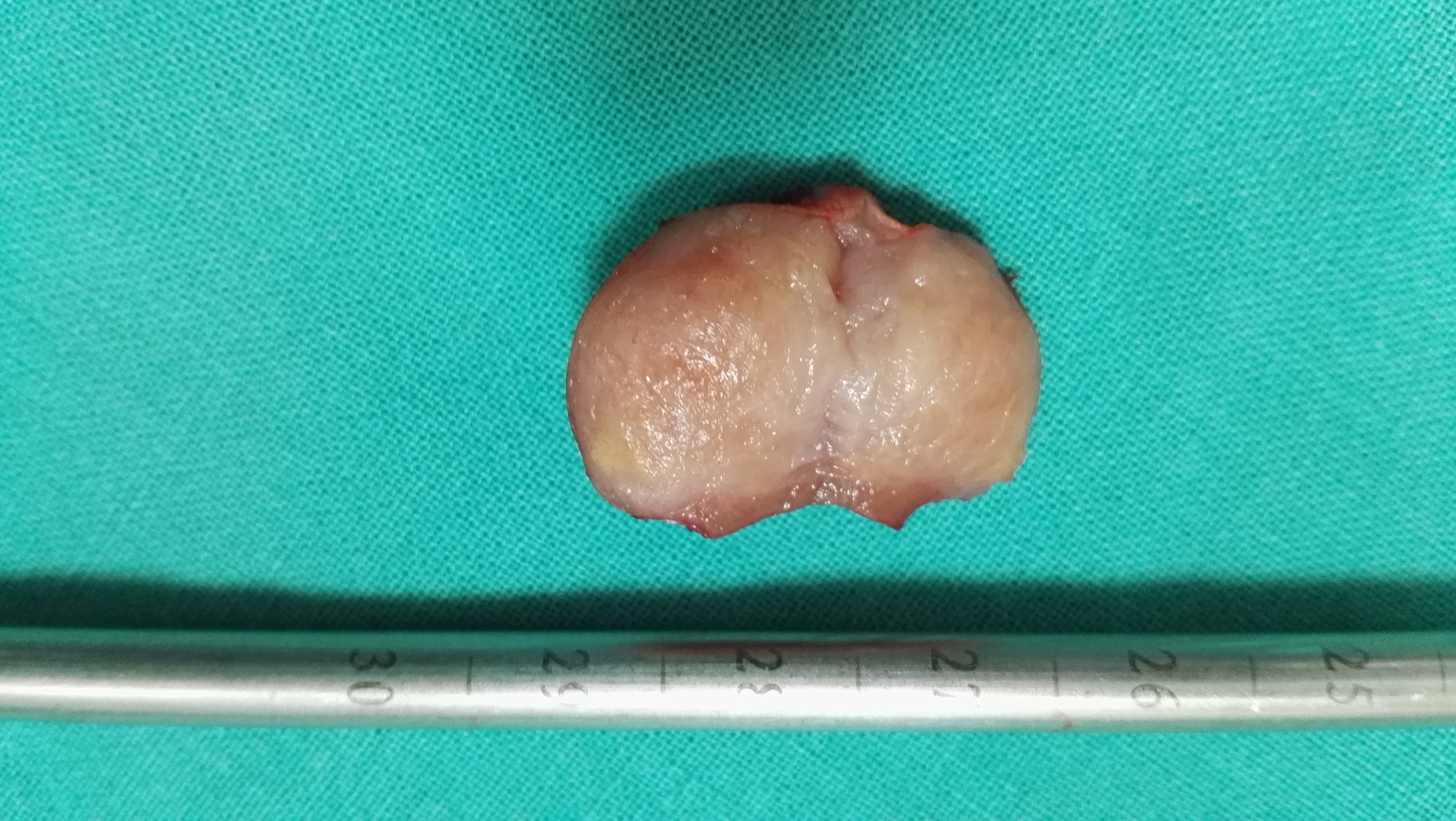 核磁共振ct怀疑的小肾肿瘤一定是恶性的吗