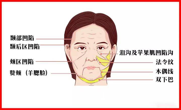 额部网格化分区与脂肪移植