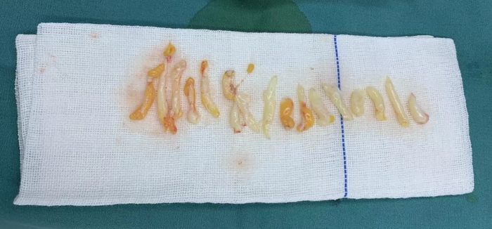 乳腺结节微创术后注意事项