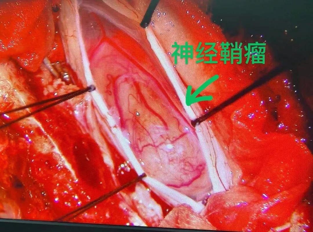 确诊患者为t8椎管内髓外硬膜下神经鞘瘤后,经患者和家属同意后尽快