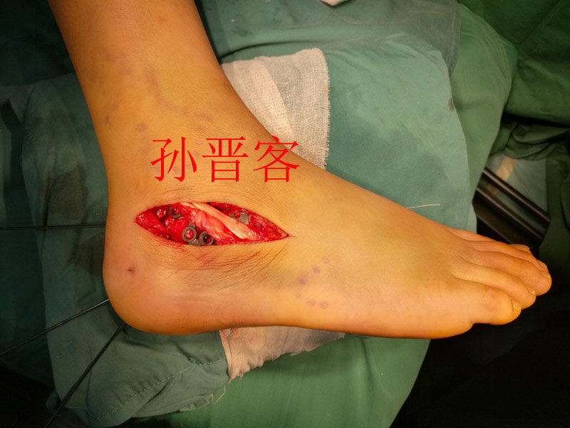 顺利愈合术后钢板固定情况,关节面平,跟骨力线恢复,载距突螺钉固定