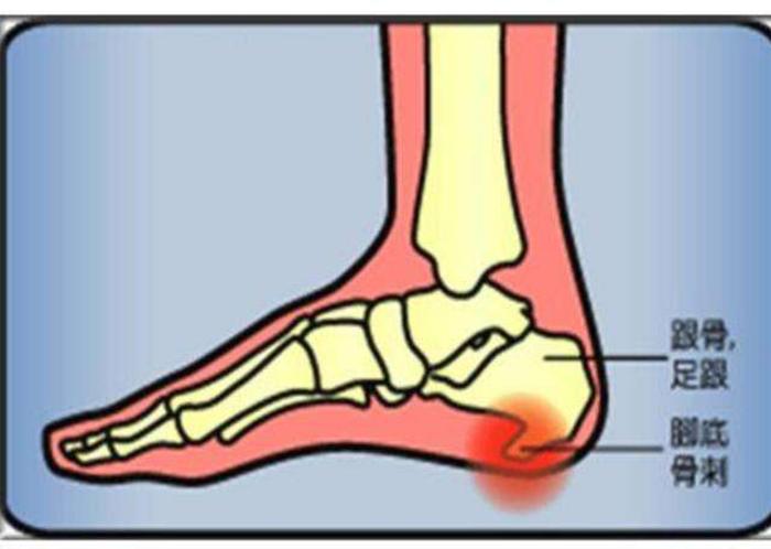 暴力撞击足跟部,易引起跟骨下脂肪垫挫伤和跟骨下滑囊炎;长久的站立