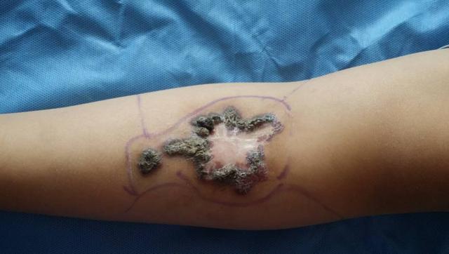 祛除婴幼儿血管瘤什么时候好弄清这个问题最重要