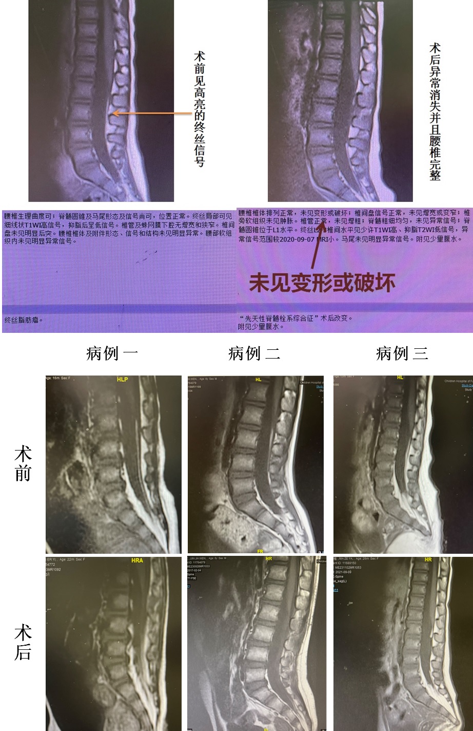 脊髓栓系症状图片