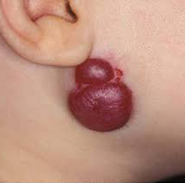 请宝妈注意这不是胎记! - 微医(挂号网)