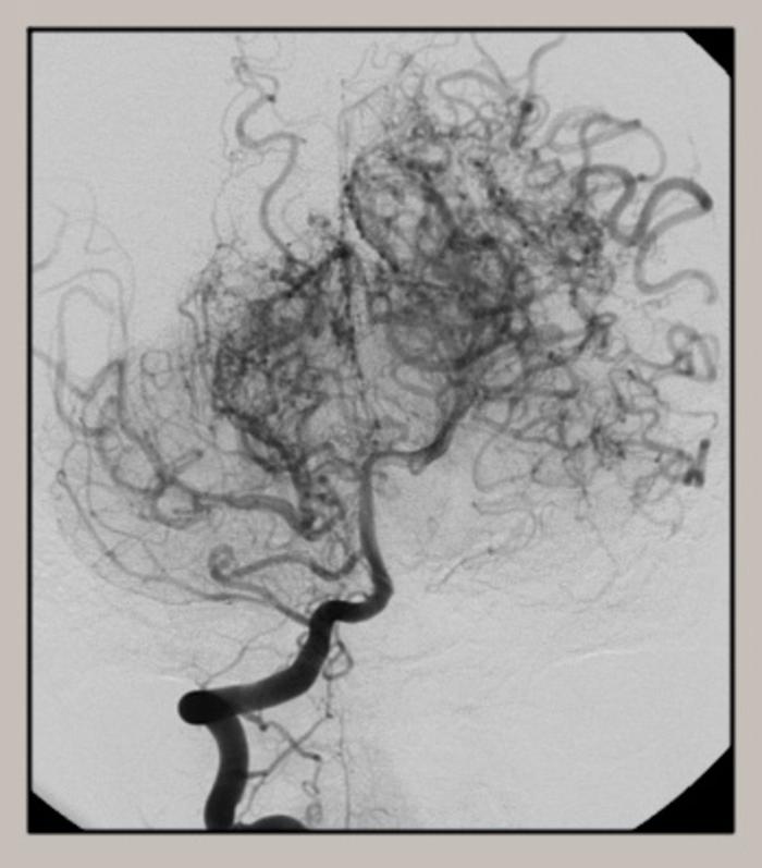 烟雾病手术并发症