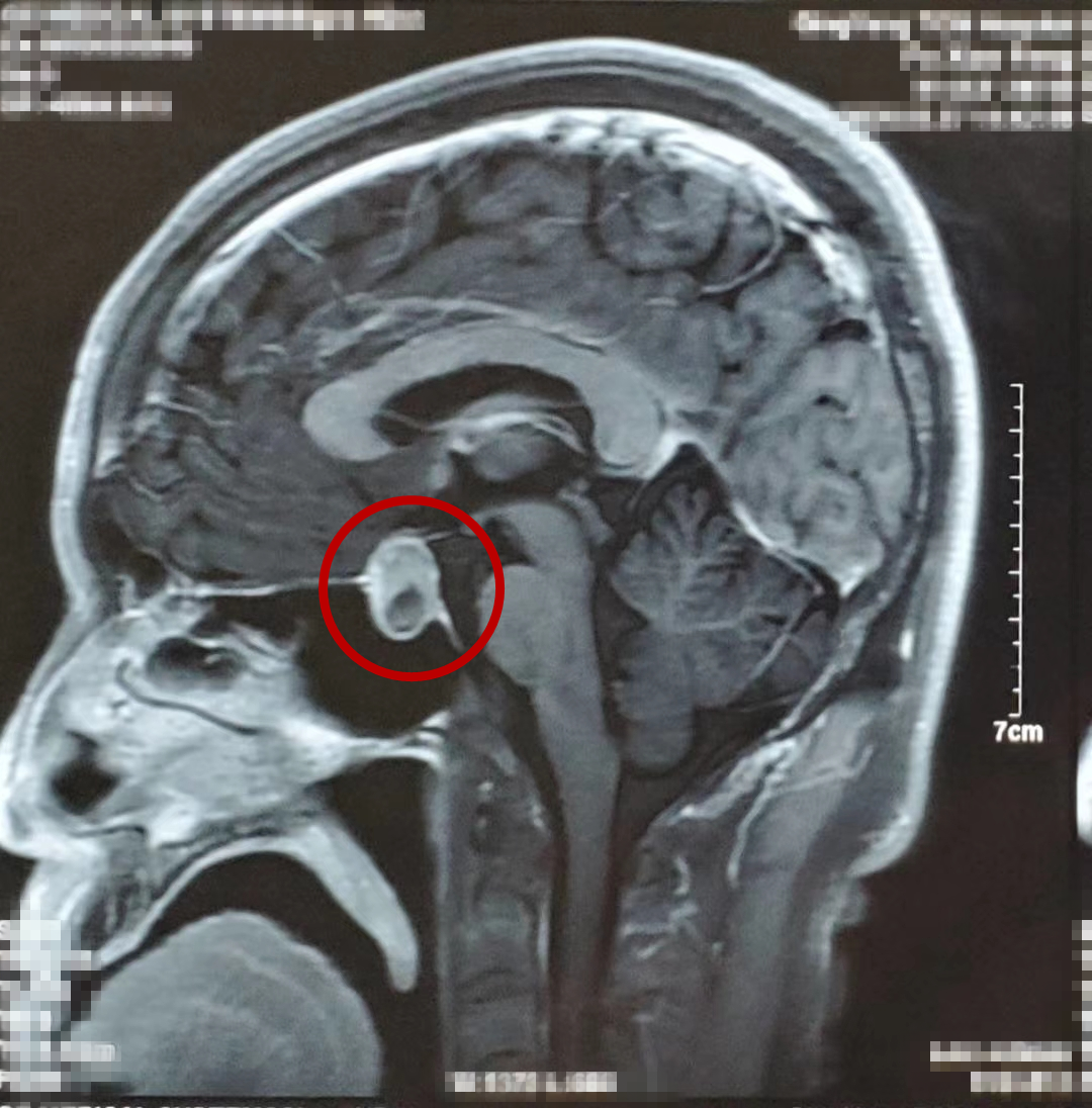 垂体瘤图片头部图片