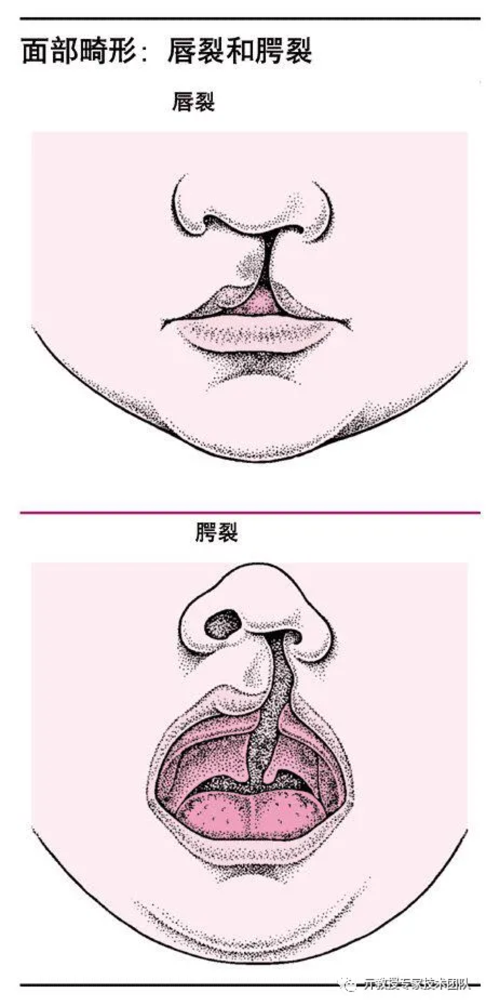 单侧唇裂需要在3-6月进行手术, 双侧唇裂手术在6-12月进行,腭裂修补