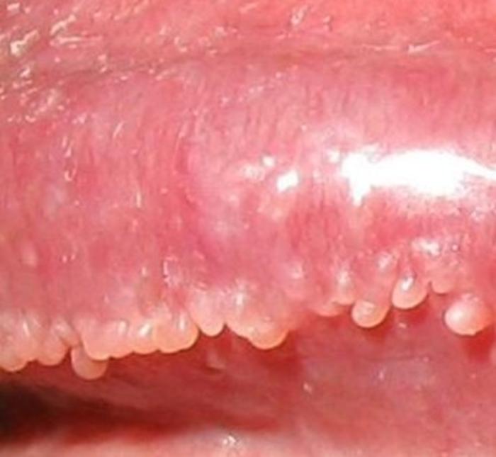 尖锐湿疣和其他病症的区分