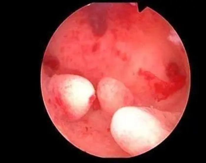 子宫内膜里长了息肉到底要不要切切了再长怎么办