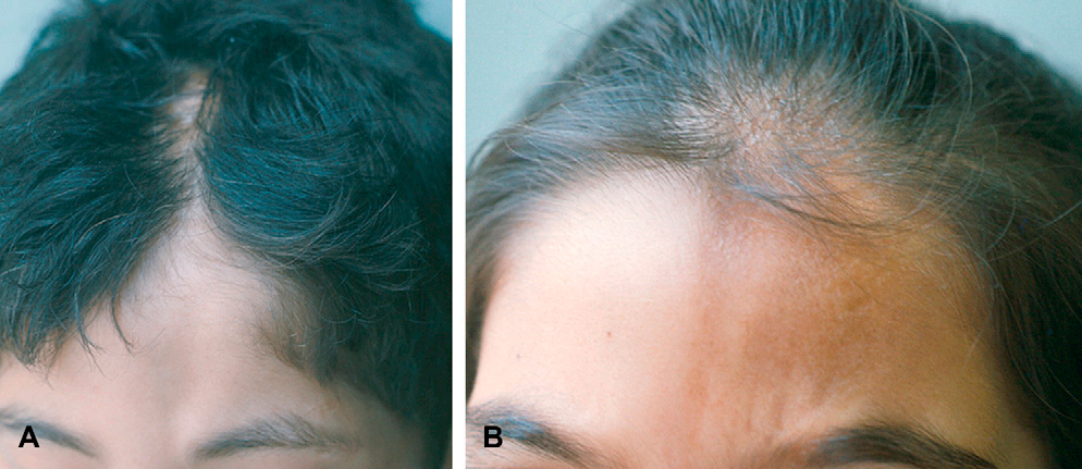 半面萎缩romberg的诊断药物治疗和手术