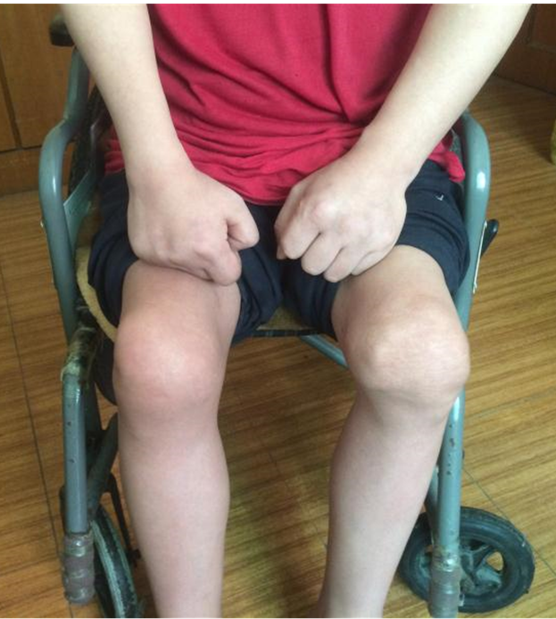 血友病合并重度膝关节屈曲挛缩畸形