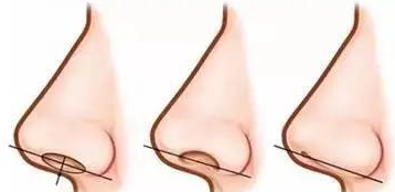 理想的鼻孔形态是完全不露鼻孔吗? - 微医(挂号网)