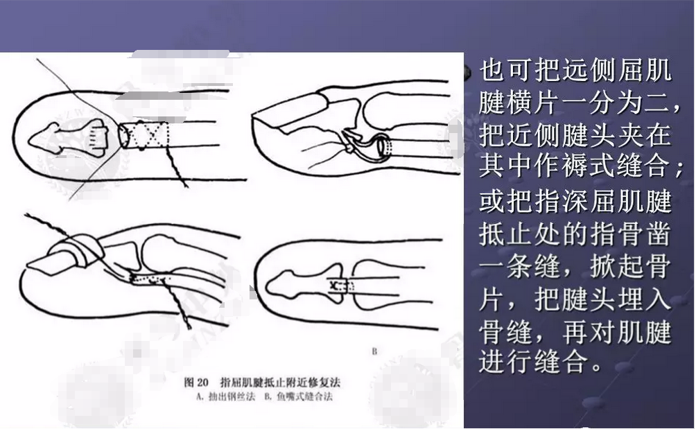 肌腱缝合法图片
