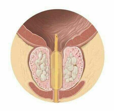 小小水囊顯神威前列腺增生患者的福音
