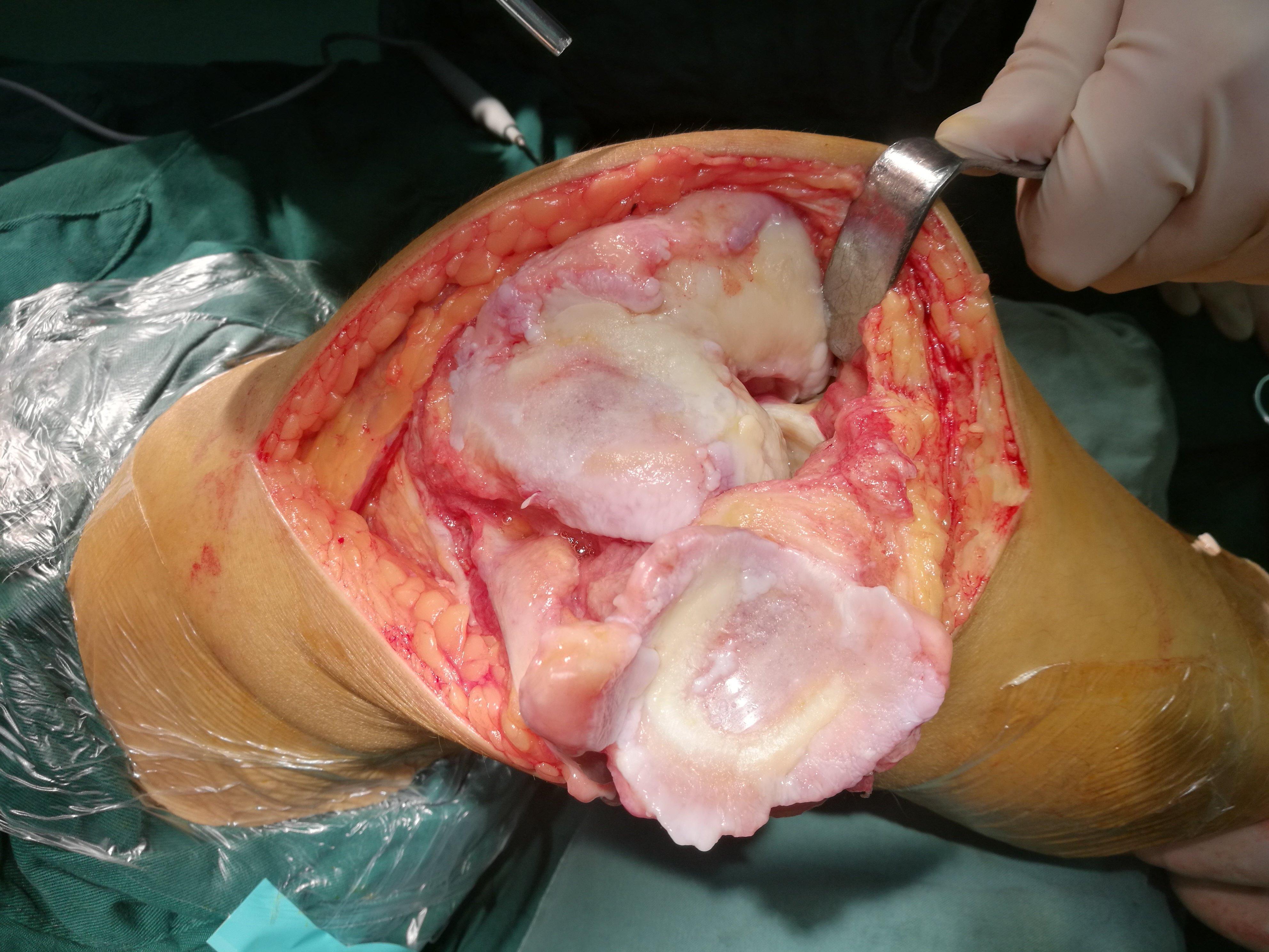 52岁女性外翻膝伴髌股关节炎dfo去旋转截骨