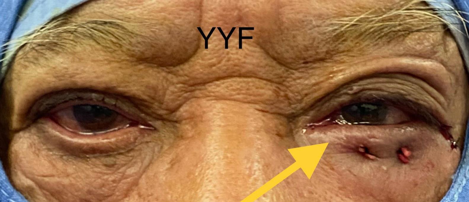 眼睑外翻的手术治疗不治疗的后续演变