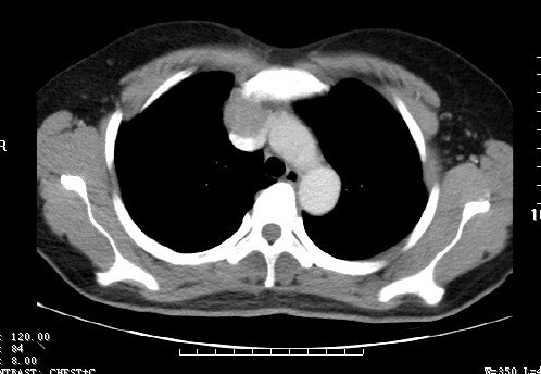 巨大侵袭性胸腺瘤的成功手术治疗