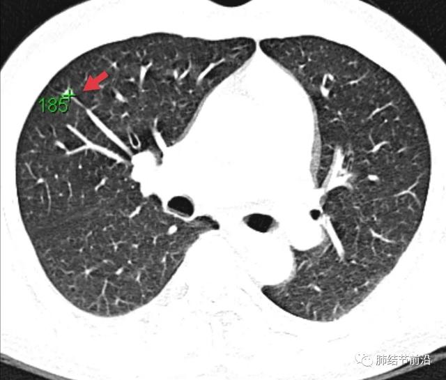 肺结节读片(5):具有决定意义的CT值 - 微医（挂号网）
