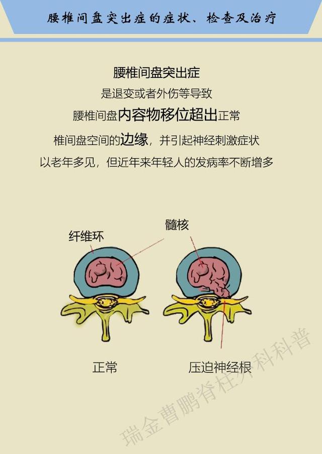 腰椎间盘突出症的症状,检查及治疗