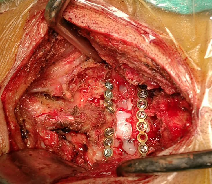 颈椎肿瘤切除及重建