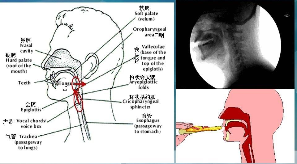 我可以安全地开始吃东西了么?—vfss(动态吞咽检查)
