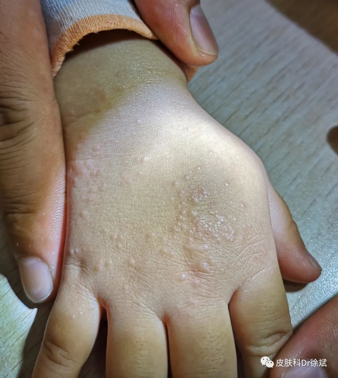 276丨宝宝玩沙子可能会玩出摩擦性苔藓样疹