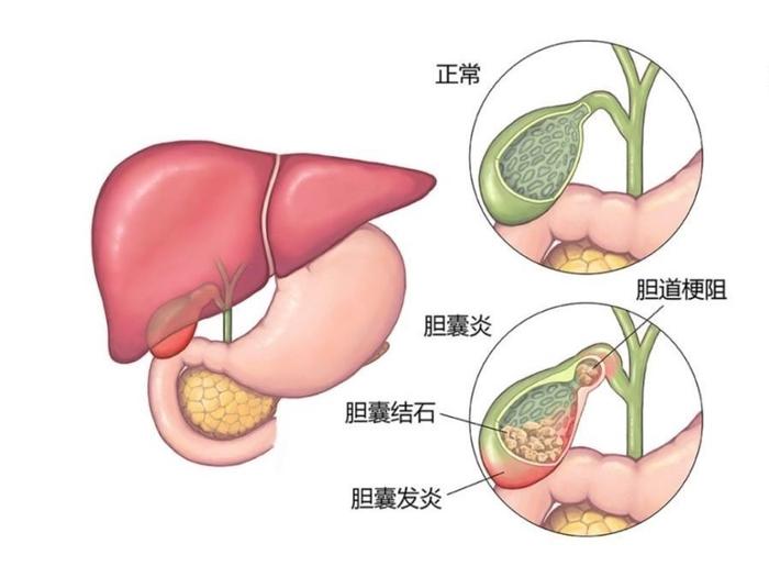 胆囊结石超微创手术单孔