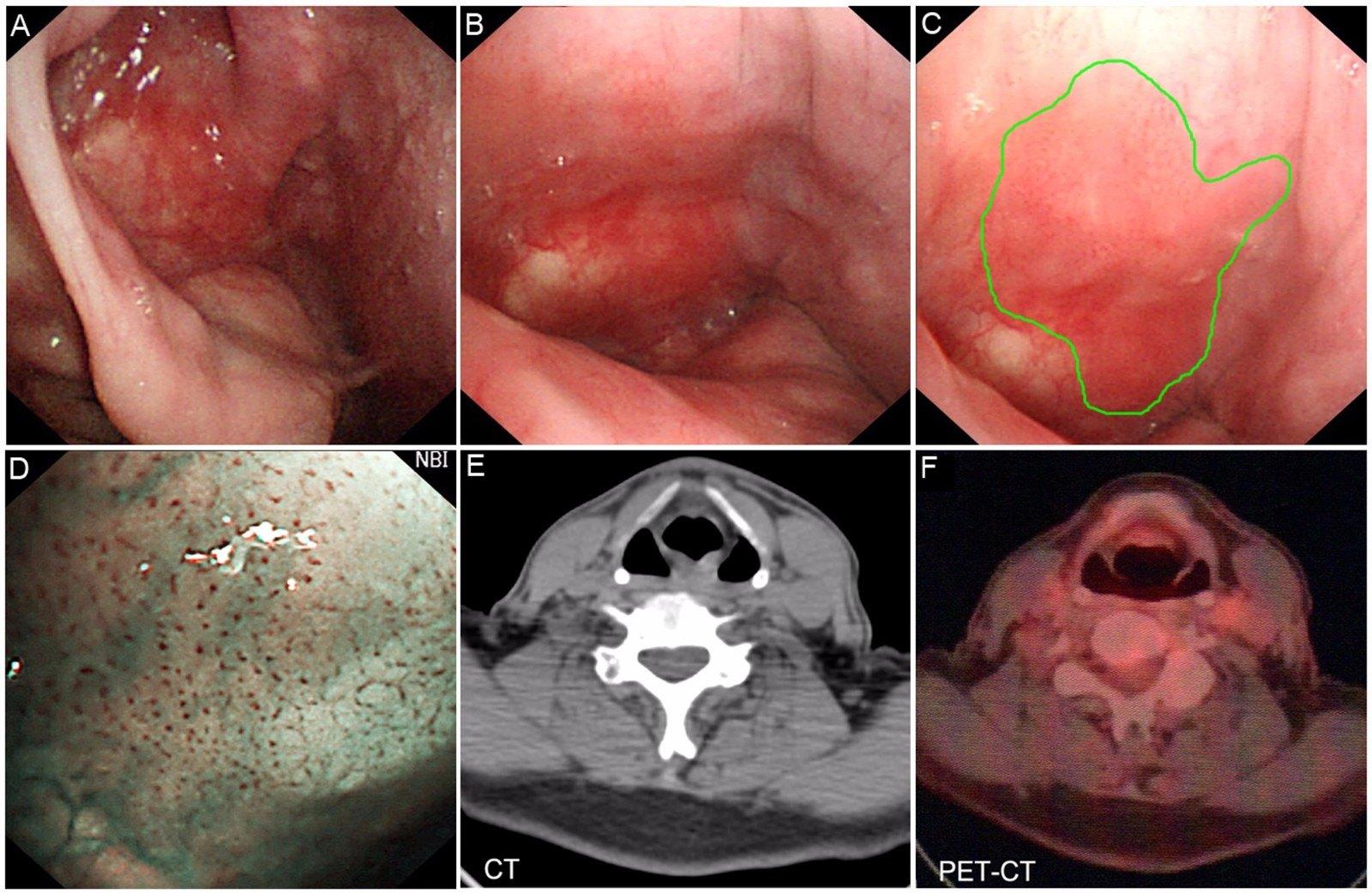 图3 右侧梨状窝早期癌a,b和c:右侧梨状窝表面尚光滑,外侧壁有片状黏膜