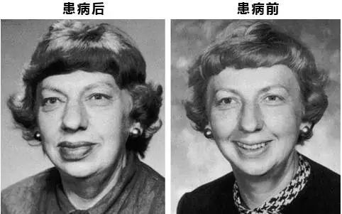 出现这种面相要小心警惕脑垂体出现问题