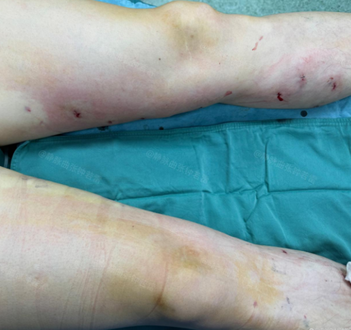 静脉曲张瘤样扩张为什么容易形成血栓