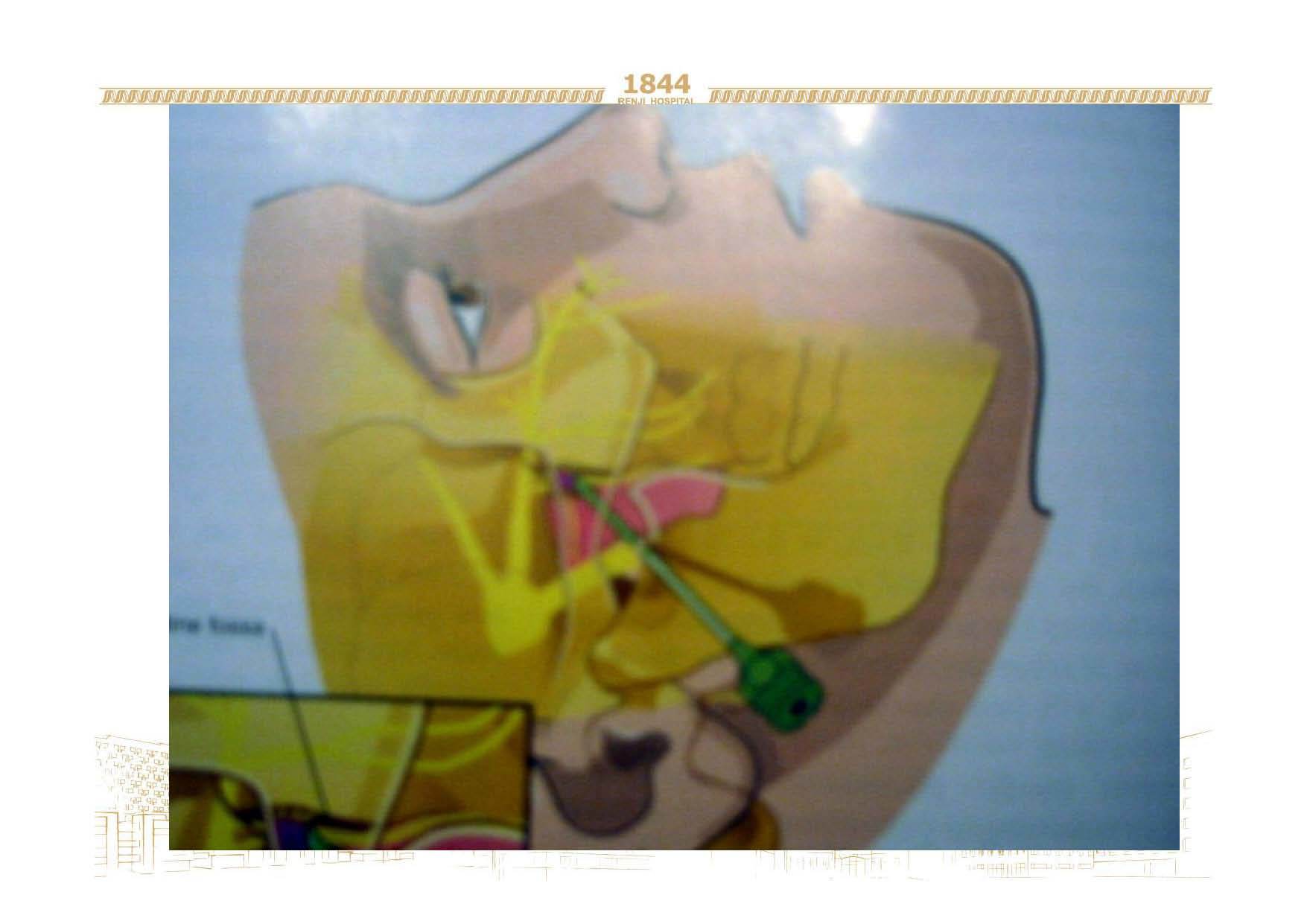 与蝶腭神经节有关的头面痛