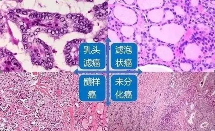 在一组对5万名甲状腺癌随访的研究中发现,乳头状,滤泡状,髓样癌的10年