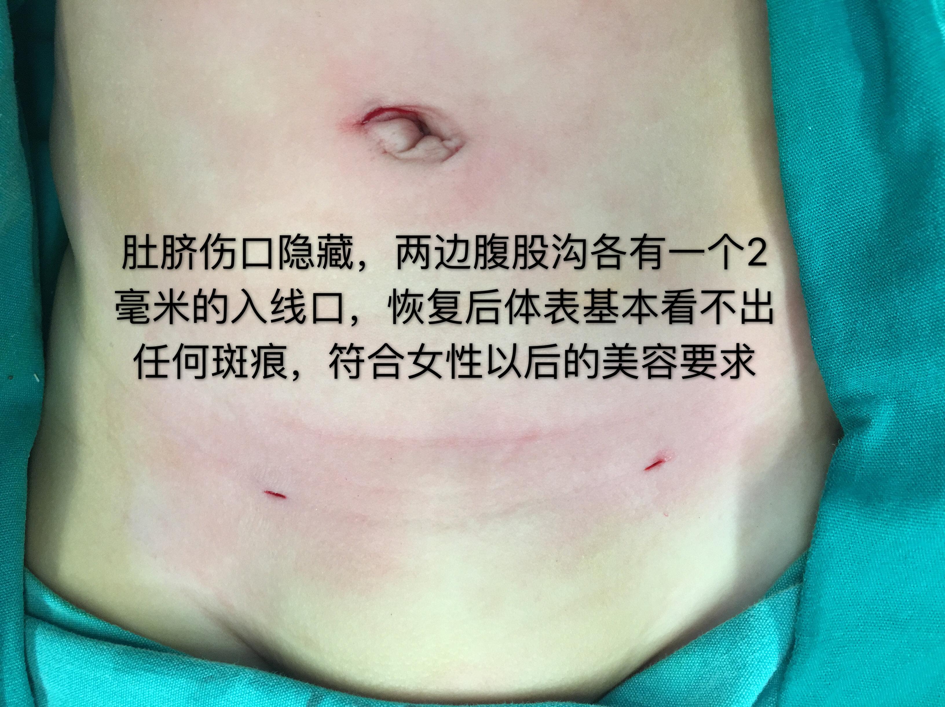 所以,腹腔镜手术是女孩子疝气,鞘膜积液手术的第一选择.